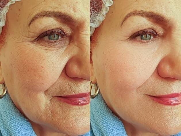 Dysport for Wrinkles: The Secret to Smoother, Younger-Looking Skin